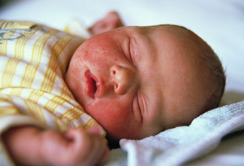 Как лечить стафилококк у новорожденного