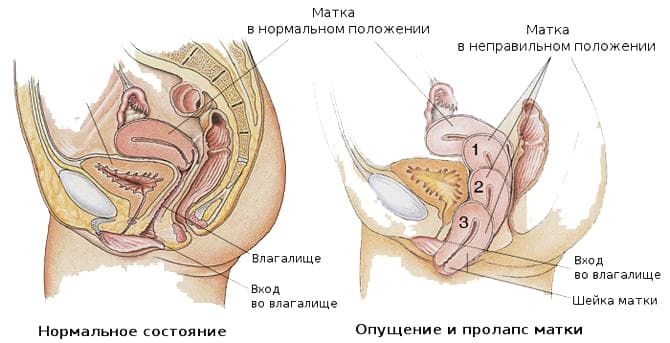 Как определить опущение матки после родов