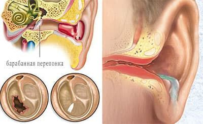 Воспаление среднего уха 