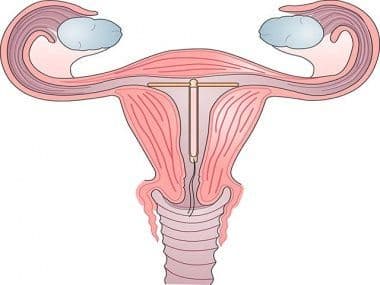 Спираль после родов