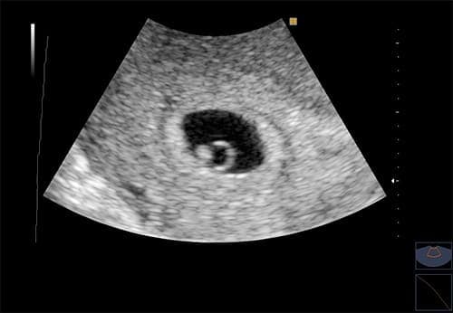 На втором месяце беременности живот большой thumbnail