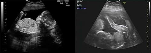 Развитие ребенка по месяцам в утробе 5 месяцев thumbnail