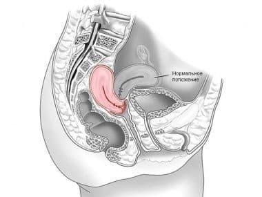 Матка кзади при беременности