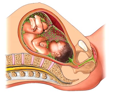 Хламидиоз при беременности последствия для ребенка