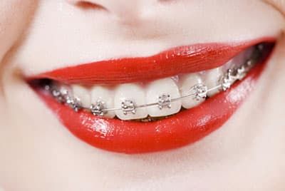 Как можно выровнять зубы при помощи брекет-системы