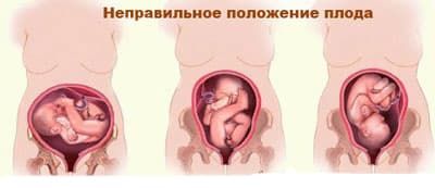 Неправильное предлежание ребенка Неправильное предлежание ребенка