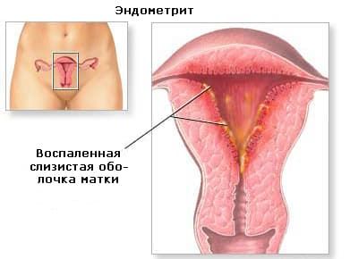 Послеродовой эндометрит