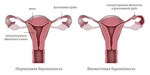 Причины внематочной беременности