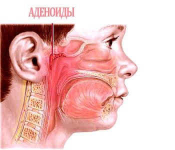 Симптомы аденоидов у детей