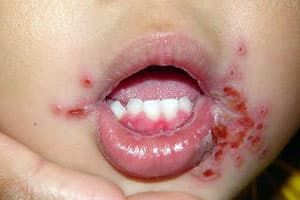 Стоматит герпетический у детей