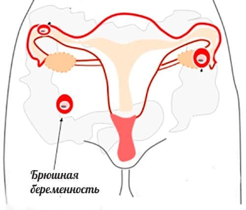 беременность в брюшной полости
