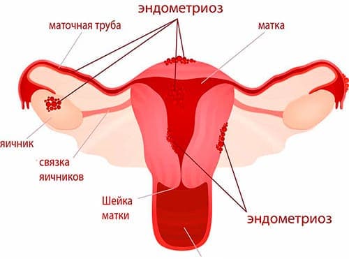 как забеременеть при эндометриозе яичников