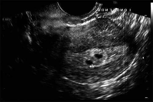 фото узи двойни на ранних сроках беременности