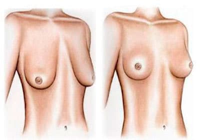 как восстановить грудь после грудного вскармливания