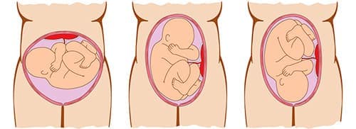 Предлежание ребенка при беременности 37