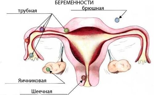 причины и симптомы внематочной беременности