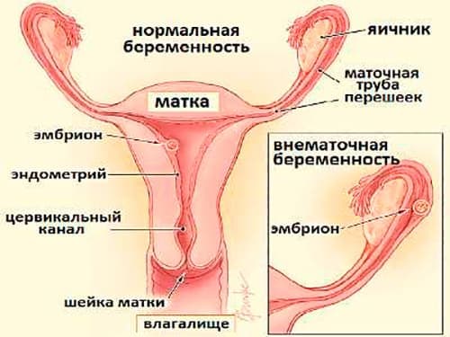 Симптомы маточной беременности