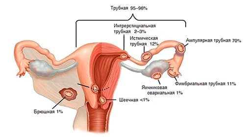 Виды трубной беременности