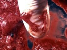 Кровотечение после аборта