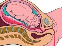 Ретрохориальная гематома при беременности