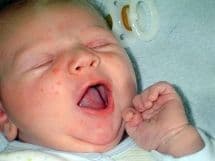 Сыпь у новорожденных на лице