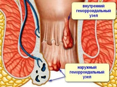 Геморрой при беременности