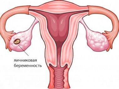 Яичниковая беременность