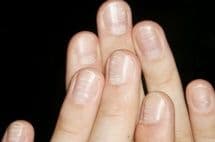 Почему ногти становятся волнистыми