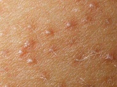 Сыпь на руках: как быстро убрать прыщи и предотвратить рецидив