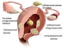 Беременность и миома матки