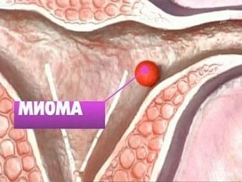 Миома матки