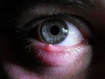 Прыщ на глазу и во рту: первая помощь и лечение дома