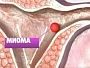 Миома матки