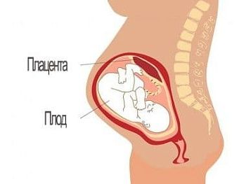 Низкая плацентация при беременности