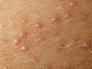 Сыпь на руках: как быстро убрать прыщи и предотвратить рецидив
