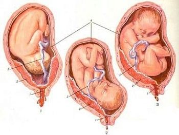 Головное предлежание плода