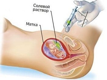 Аборт по медицинским показаниям