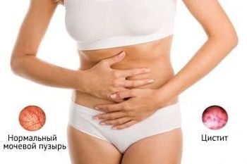 Цистит после секса